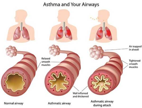 asthma and your airways