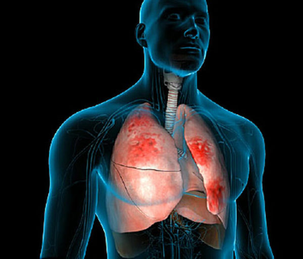 Пневмония - это: симптомы, диагностика и лечение