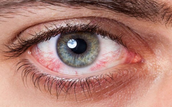 Можно навсегда вылечить Синдрома сухого глаза этими 3 методами